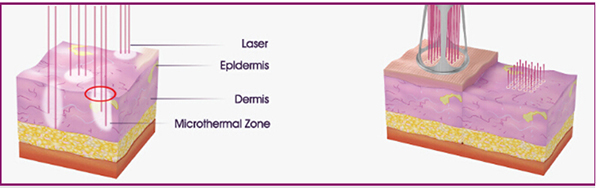 8.4'' Color Screen RF Fractional Laser Equipment For Skin Rejuvenation / Vaginal Tightening