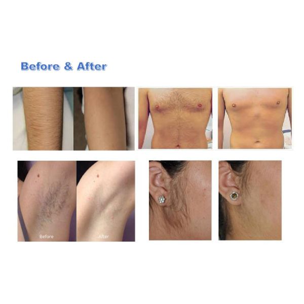 755 808nm Alexandrite Laser Beauty Machine / Diode Laser Hair Removal Machine