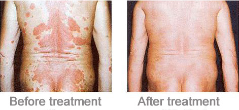 Phillip UV Lamp UVB Phototherapy Equipment For Treatment / Psoriasis / Vitiligo