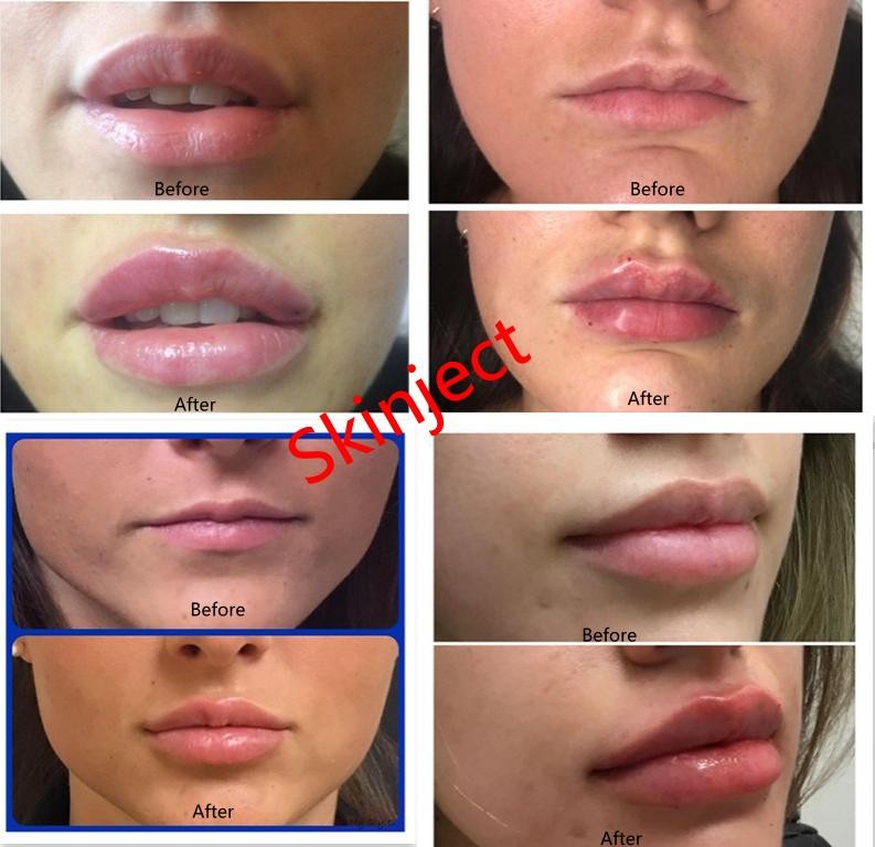 Juvederm Гиалуроновая кислота для личного наполнения кожи для инъекций для наполнения губ