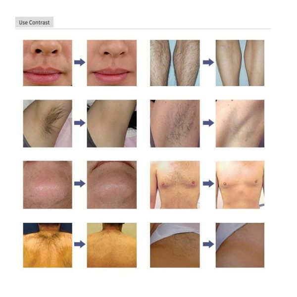 60Hz Opt Shr Ipl Hair Removal Machine Pain Free Intense Pulsed Light