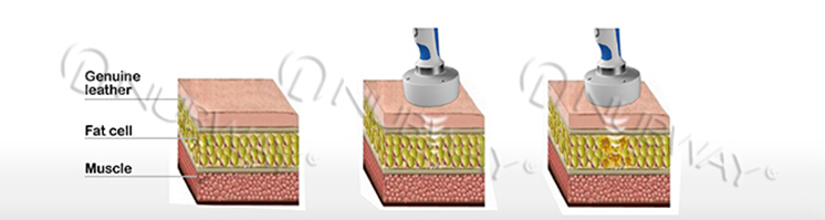 New beauty equipment 13mm focus depth hifu cellulite reduction body weight measuring machine with 10 inch touch screen