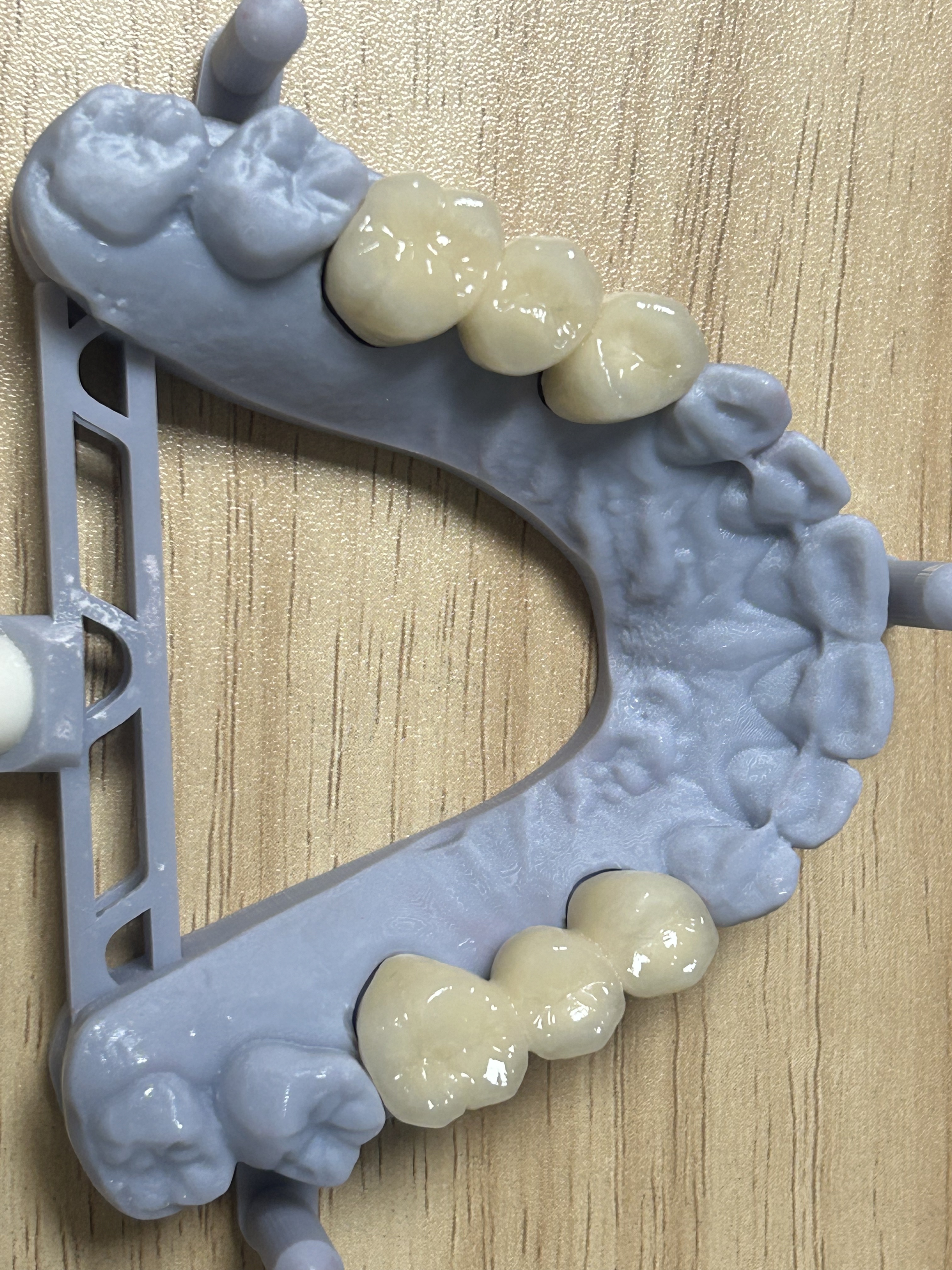 High Strength Metal-Free Full Zirconia Dental Crown