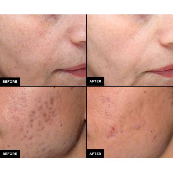 Dermal Picosecond Laser Tattoo Removal Machine Skin Lightening Air Cooling