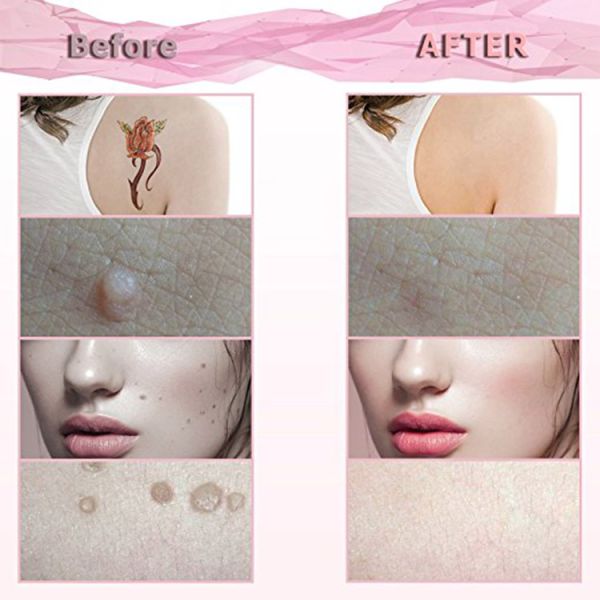 Plasma Pen Skin Tag & Mole Remover Skin Tags USB Charging Beauty Device