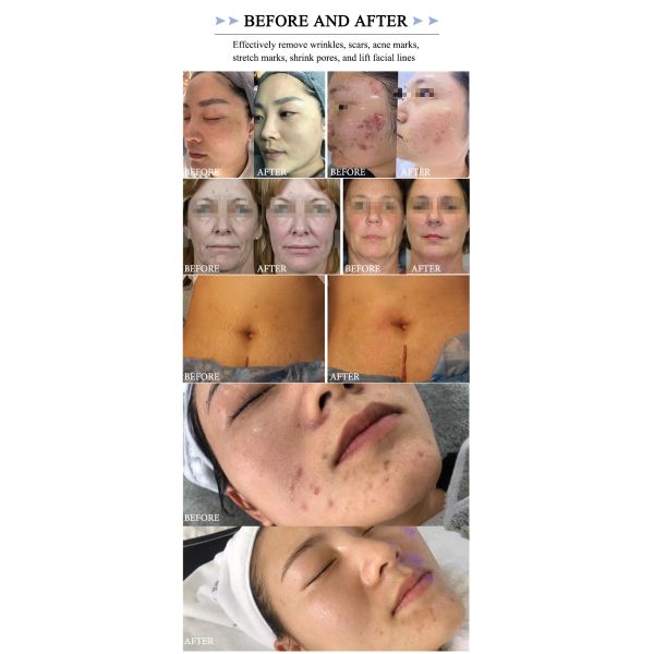 equipo de spa de salón de belleza de radiofrecuencia fraccionada máquinas faciales máquina de masaje de contorno corporal rf