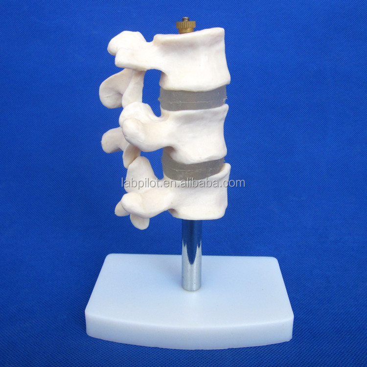 Advanced PVC Educational Models Cutaway Osteoporosis of Spine Lesions of Lumbar Vertebra