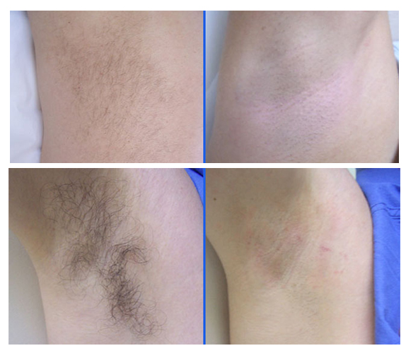 Clinic Diode Laser Hair Removal Machine Customized Language Triple Cooling System