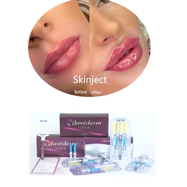 Juvederm Hyaluronic Acid Facial Dermal Filler Injectable 2*1ml Packing