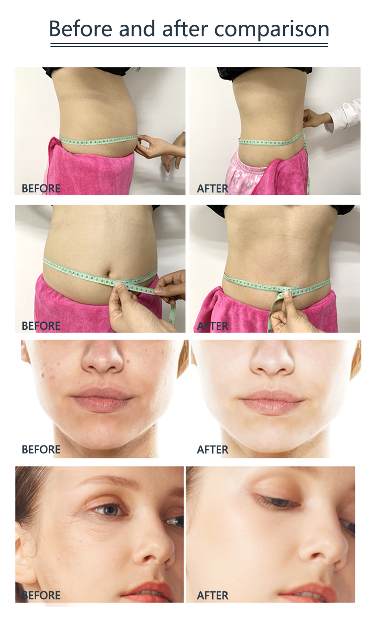 Sistema de cavitación al vacío Ultra cavitación RF cuerpo adelgazante máquina de belleza uso doméstico equipo de pérdida de peso