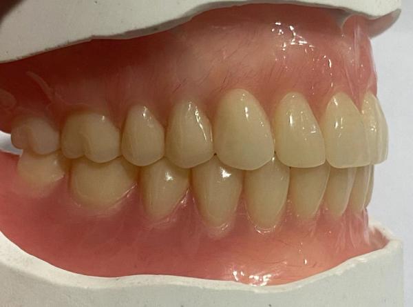 Hypoallergenic Customized Removable Partial Denture With Pink Gum Color