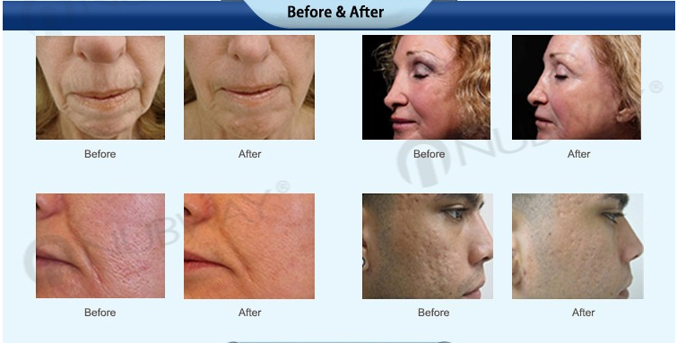 CE /FDA approved technology nubway newest fractional rf microneedle/microneedling machine/leading beauty