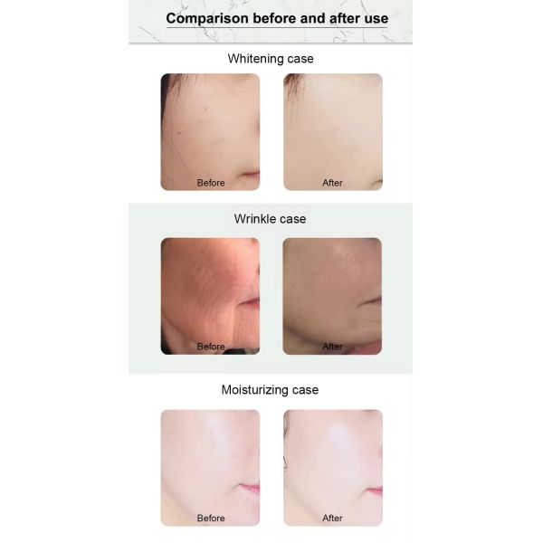 Professional Hydro Microdermabrasion Machine Ultrasonic Micro Dermabrasion Machine