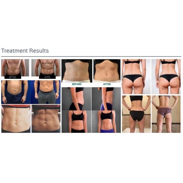 Тонизировать ручки машины 4 магнитного тела скульптора Emslim Tesla бедер ваяя