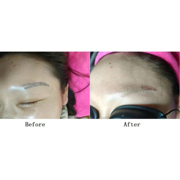 Профессиональные лазерные машины для удаления татуировок Nd Yag