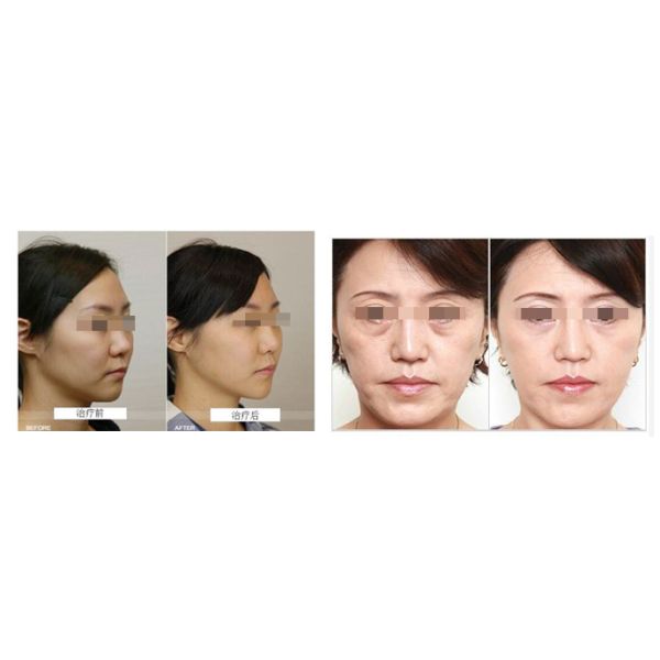 Mini Salon Use Hifu Facelift Treatment Wrinkle Removal Sagging Skin Therapy