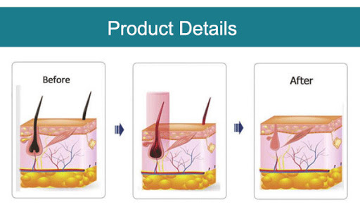 Q Switch Nd Yag Лазерная машина для углеродной очистки Удаление веснушек Удаление татуировки