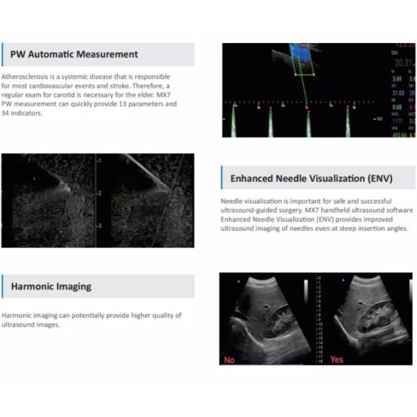 Portable Handheld Wireless Probe Type Ultrasound Scanner 2mhz