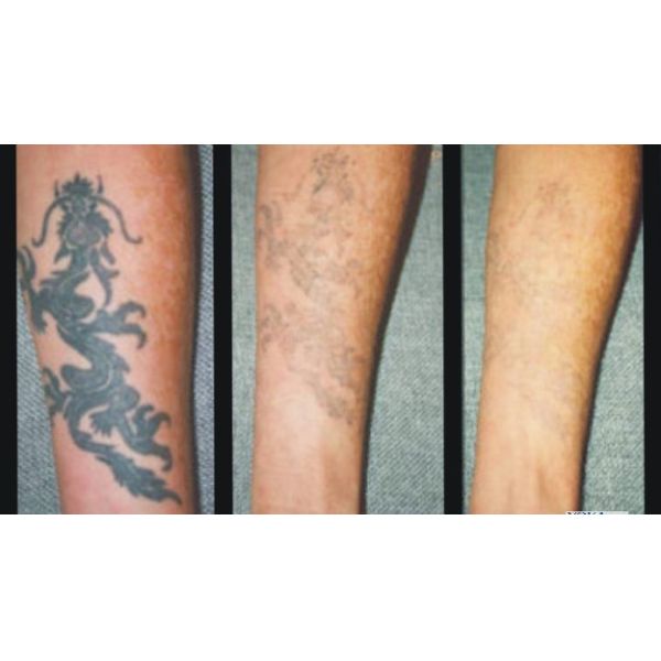 Tattoo ink removal Q Switched ND-yag Laser Machine