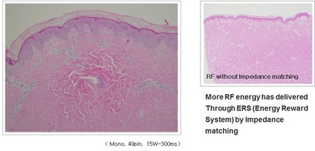 Fractional RF Microneedle For Wrinkle Removal / Skin Tightening