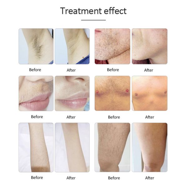 3 Wavelength Diode Laser Hair Removal Machine For Permanently Hair Removal