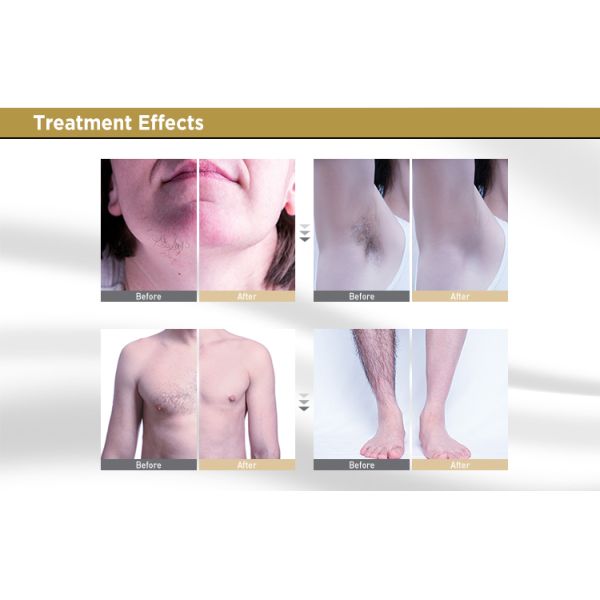 Beinjing Adss Vertical Four Wavelengths 940/755/1060/808nm Diode Laser Hair Removal Machine Diode Laser Hair Removal