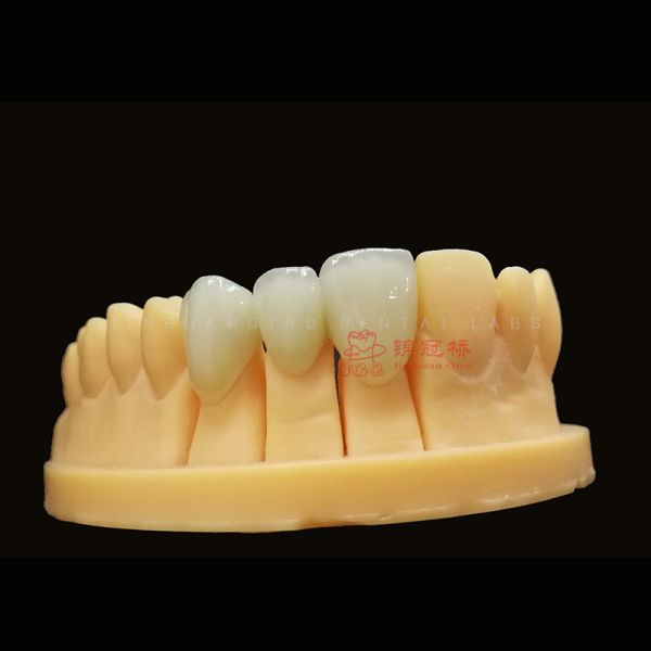 Natural Translucent Zirconia Restorations Custom Designed For Anterior Teeth