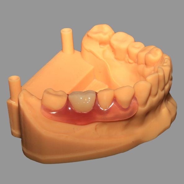 Flexible Denture Price | ChinaCasting Valplast Dental Partials Unilateral Design