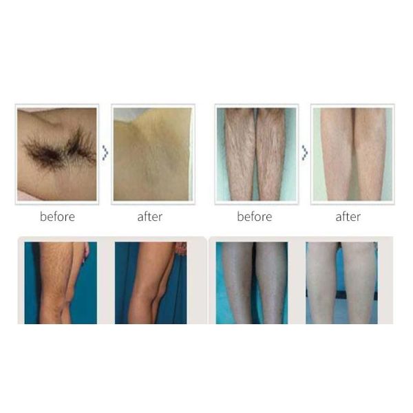 1000Mj лазер диода машины 755nm 808nm 1064nm корки углерода лазера ND YAG