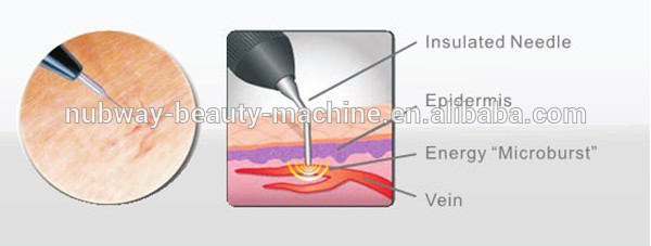 30Mhz High frequency new ! High Frequency spider veins remover RBS Vascular machine
