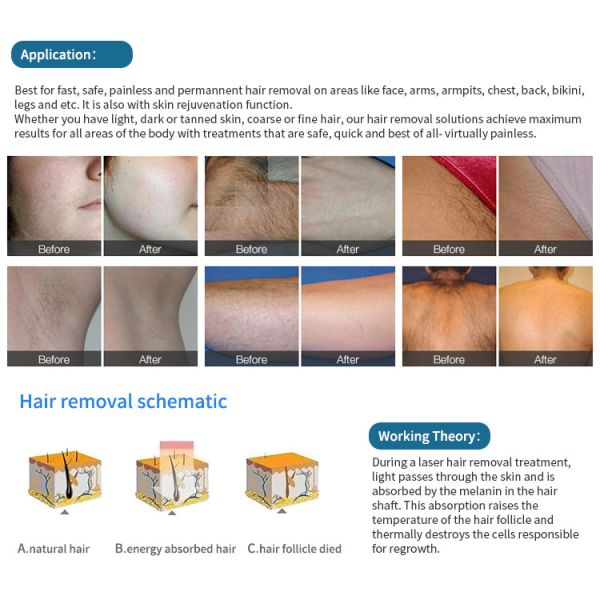 808nm Diode Laser Hair Removal Machine With Cooling System For Salon