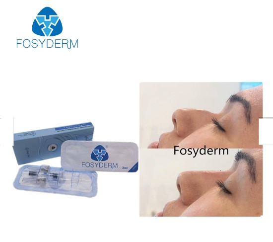 Крест Fosyderm соединил глубокую линию заполнитель заполнителя 2ml дермальный для носа вверх