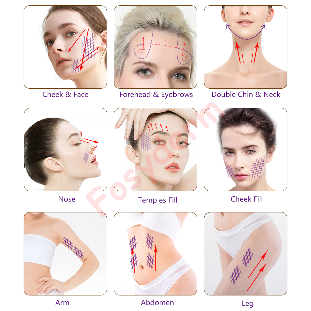 кожа подъема потока 26G 27G медицинская Mono PDO затягивая губы подъема потока PDO