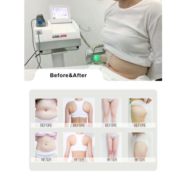 Pain Treatment Physical 80KPa Shockwave Therapy Equipment