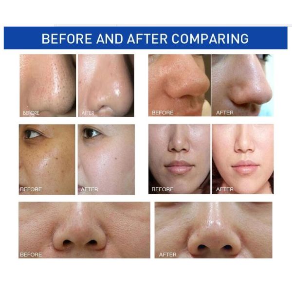 300W Hydrafacial Machine , Cold Hammer Oxygen Jet Hydrafacial Microdermabrasion Machine