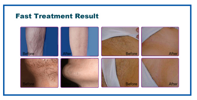 Professional Beauty Laser Hair Removal Equipment / Laser Diode Hair Removal Machine