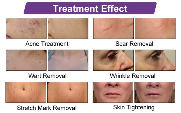 BV13 Vertical 30w 60w Co2 Laser Beauty Equipment For Salon With Ce Approval Co2 Fractional Spot Scar Removal Laser