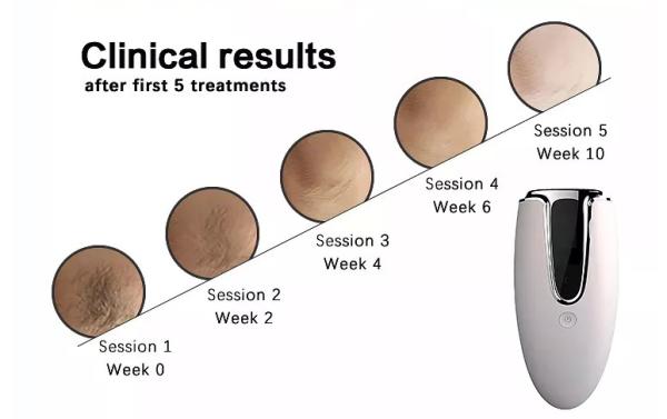 Limpeza portátil da máquina do ipl da remoção do cabelo do laser do IPl da forma do uso da casa facial com terapia clara conduzida