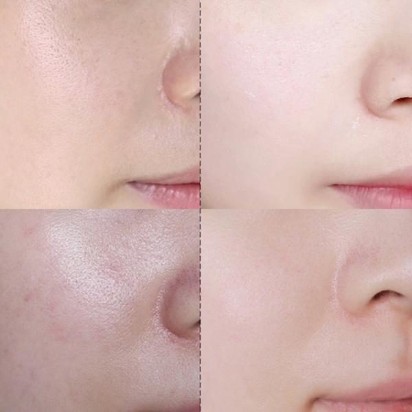 o tratamento final da acne do creme do ponto 30g ilumina e repara o creme de cara