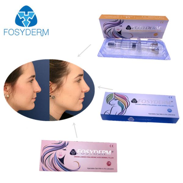Заполнитель вводимого геля 5ml Hyaluronic кисловочный дермальный для лицевого подмолаживания
