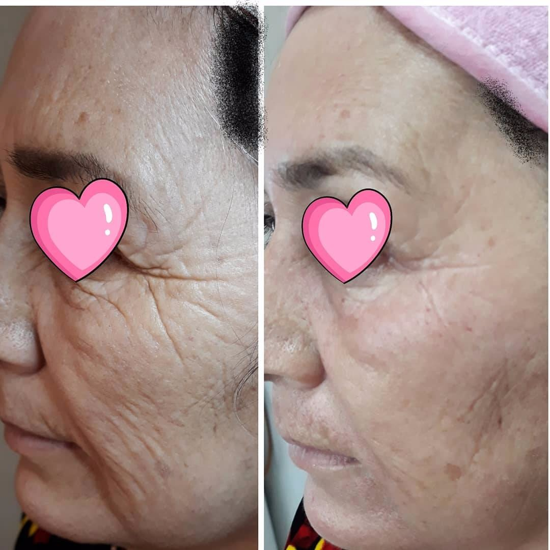 2017Hot sale Fractional RF and Microneedle RF beauty Machine/fractional micro-needle rf skin