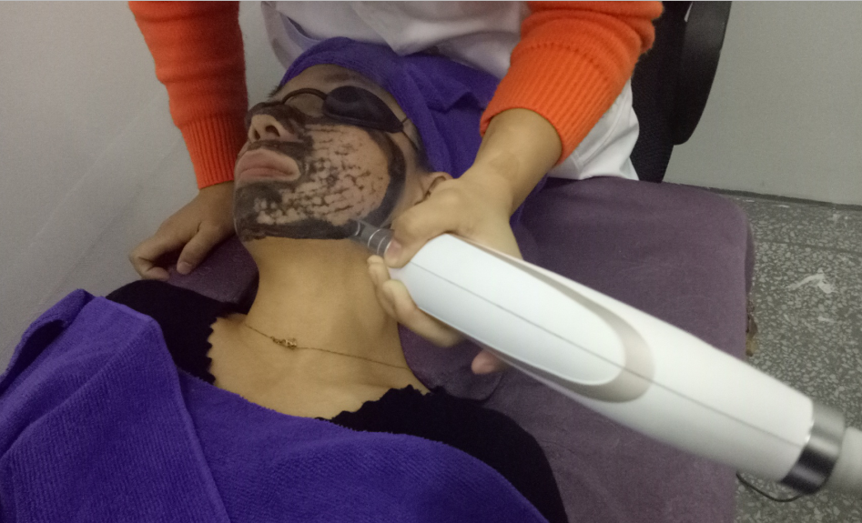 dispositif de laser de diode de chargement initial de 300W YAG pour l'épluchage de carbone de retrait de sourcil