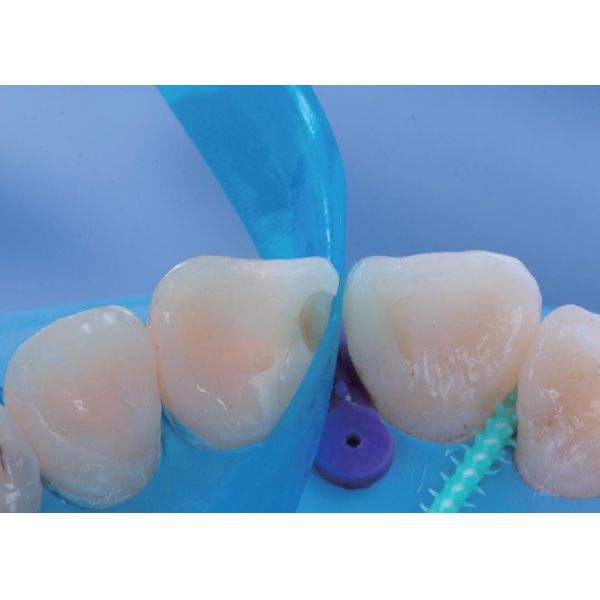 Sectional Contoured Anterior Matrix Band Dental Anterior Teeth Matrix M8