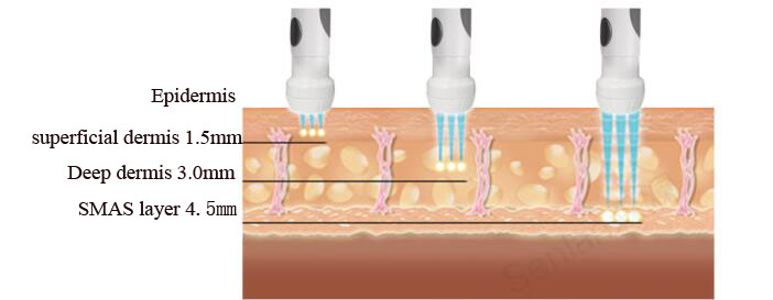 Анти- старея ледяная скульптура радиолокатора оборудования красоты РФ лицевая для удаления морщинки