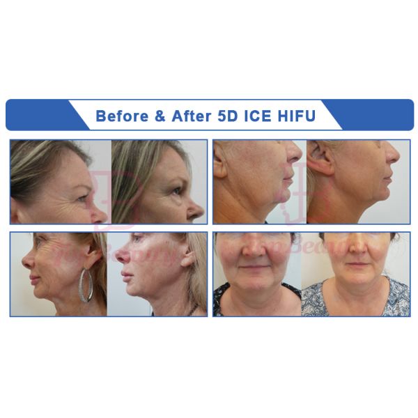 оборудование морщинки Cryo портативной HIFU лицевой машины заботы кожи 5D анти-