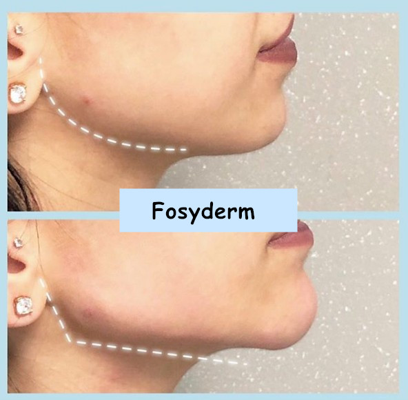 Заполнитель Fosyderm глубокий дермальный для кислоты Chin HA носа Hyaluronic