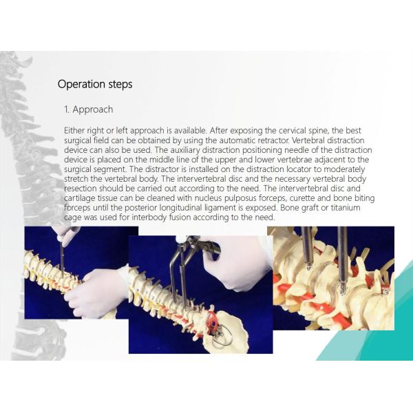 Spine Anterior Cervical Plate Titanium Cervical Plate Implant Orthopedic Surgery CE Certification