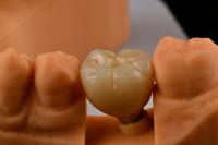 Implantes dentales de un solo diente con conexión hexadecimal interna