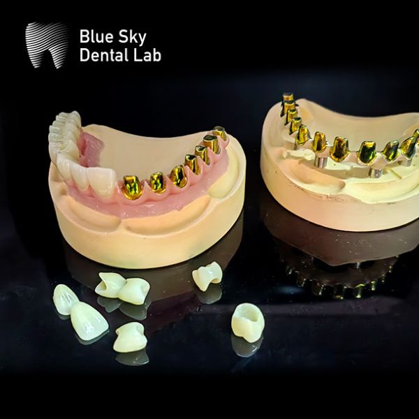 Шрубы удержаны MUA опоры Имплантантные корпуса Циркониевые короны Многослойный розовый фарфор с легким ремонтом