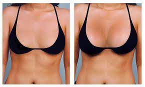 5ml Fosyderm Facial Filler Injection For Breast Butt Penis Enhancement